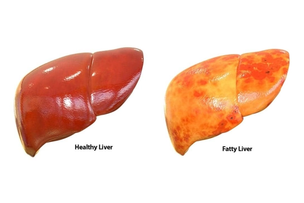 مقایسه کبد چرب و کبد سالم برای درمان کبد چرب